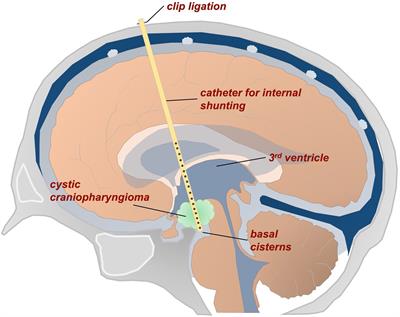 Risk-benefit analysis of surgical treatment strategies for cystic craniopharyngioma in children and adolescents